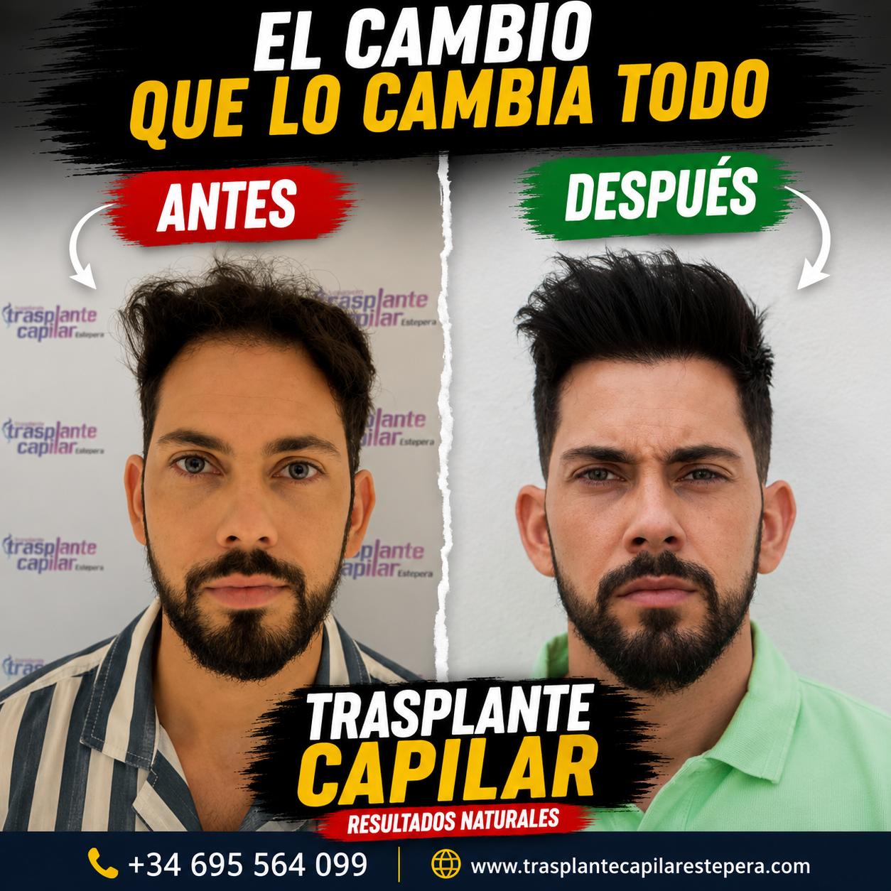 Trasplante capilar antes y después — resultado natural de un paciente de ESTEPERA España