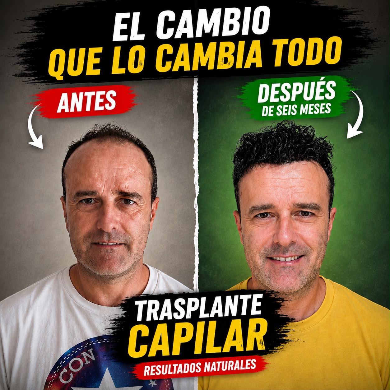 Trasplante capilar en Turquía: antes y después a los 6 meses, resultado natural — paciente de ESTEPERA