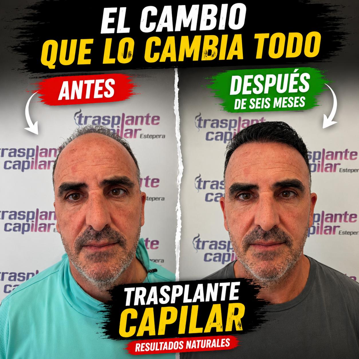 Injerto capilar antes y después a los 6 meses, resultado natural — ESTEPERA, representante de Estepera Hair Clinic en España